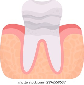 Enamel Erosion Tooth Problem Vector Illustration