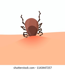 Encephalitis tick bites isolated on white background. Mite insect vector illustration. Wild or domestic tick, skin parasites. House dust mite allergy.