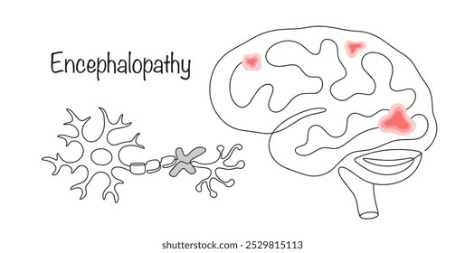 Encephalopathy. Non-inflammatory brain damage, leading to the death of neurons and the appearance of small foci of hemorrhage. A simple hand-drawn illustration with a medical theme.