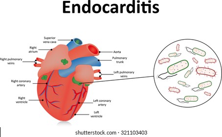 Endocarditis