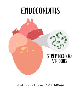 Endocarditis. Inflammation Of The Heart - Endocardium. Streptococcus Viridans. Vector Flat Cartoon Illustration. Perfect For Banner, Medical Brochure, Flyer