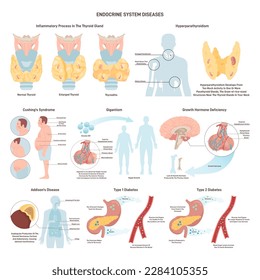 Endocrine system organ disease set. Human glands function disorders. Two types of diabetes, pituitary, adrenal and thyroid gland. Anatomy educational infographic. Flat vector illustration