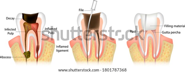 Endodontic root canal treatment process.\
Dentistry, dental restoration concept. Tooth decay caries disease\
development