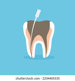 Limpieza endóntica de raíces y proceso de tratamiento de caries. Salud dental. Ilustración vectorial en un estilo plano de moda.	
