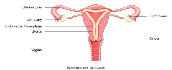 Hiperplasia endometrial Utero del sistema reproductivo femenino en diferentes estilos diagrama con inscripciones texto Vista frontal en un corte. Anatomía humana órganos internos plan de localización de enfermedades icono de estilo plano