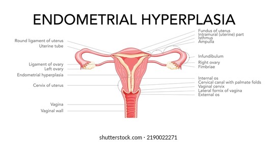 Hiperplasia endometrial Utero del sistema reproductivo femenino con inscripciones diagrama médico. Vista frontal en un corte. Anatomía humana órganos internos plan de localización de enfermedades icono de estilo plano