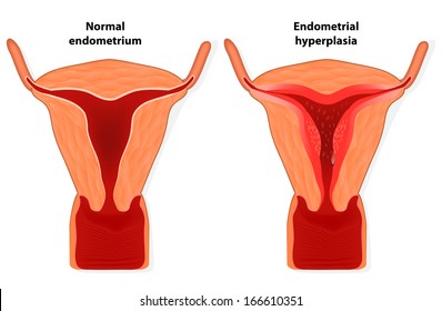 Endometrial Hyperplasia Is An Overgrowth Of Tissue In The Endometrium Uterus.  The Uterine Lining Becomes Too Thick Which Results In Abnormal Bleeding.