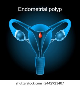 Endometrial polyp. Cross section of a human uterus with Uterine polyp. female reproductive system. Vector illustration like X-ray image. Reproductive health.