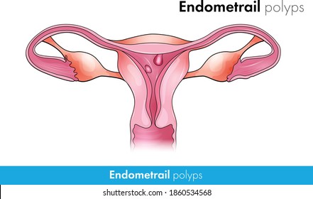 cancer endometrial polyp