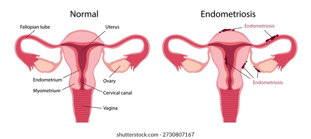 Endometriosis. Diagrama de comparación que muestra un útero normal y endometriosis. La ilustración normal del útero incluye etiquetas para la trompa de Falopio, útero, ovario, endometrio, miometrio, canal cervical.
