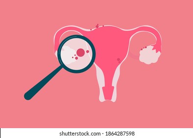 Endometriosis concept illustration for medical content or educational purpose.