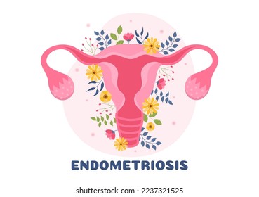 Endometriosis with Condition the Endometrium Grows Outside the Uterine Wall in Women for Treatment in Flat Cartoon Hand Drawn Templates Illustration