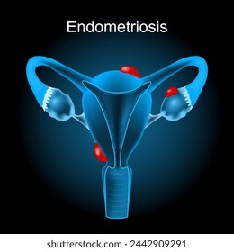 Endometriosis. Cross section of a human uterus with Endometrial tissue. female reproductive system. Vector illustration like X-ray image. Reproductive health.