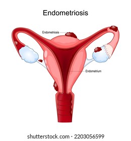 Endometriosis. Female Reproductive System. Human Uterus With Cells Endometrium That Grow Outside The Uterus. Female Diseases. Vector Poster