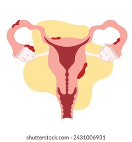 endometriosis female reproductive system ovary adhesion in flat illustration