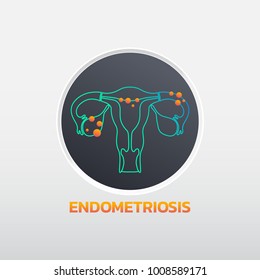 Endometriosis Icon Design, Infographic Health. Vector Illustration.