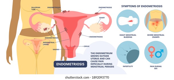 Endometriose die Gewebsstörung innerhalb einer Uterusinfektion