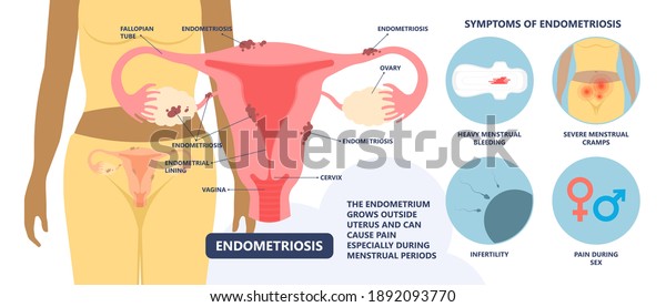 Endometriosis Pain Pcos Tissue Cancer Cyst Stock Vector (Royalty Free ...