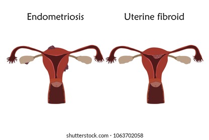 Endometriosis Uterine Fibroid Human Realistic Uterus Stock Vector ...