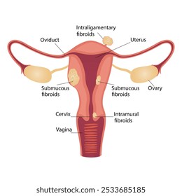 endometriosis, uterine fibroids, gynecological cancer, subserous fibroids and cervical, vaginal