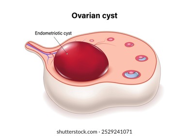 Endometriotic cyst cross section vector. Ovarian cysts. Female ovarian disease.