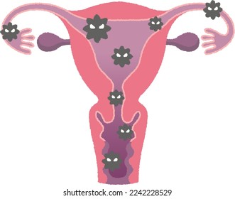Endometritis is inflammation of the lining of the uterus called the endometrium. Bacterial infection is the main cause.