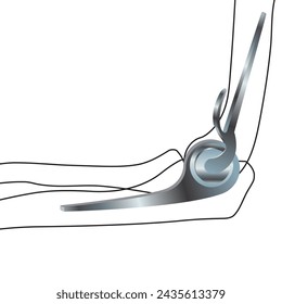Prótesis endoprotésica, prótesis articular del codo. Ilustración vectorial. Afiche médico