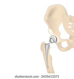 Endoprosthetics, hip joint prosthesis. Vector 3D illustration. Medical poster