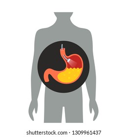 Endoscope Light On Examination In The Stomach. Flat Vector Illustration