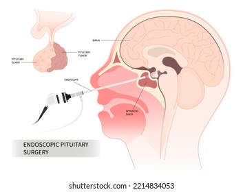 endoscopic pituitary surgery for cushing disease disorder Growth of adrenocorticotropin adrenal cortisol Transcranial Oxytocin Follicle stimulating Microadenomas and Macroadenomas anatomy