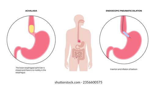 Endoscopic pneumatic dilation. Upper endoscopy minimally invasive procedure. Disorder of the esophagus, therapy for achalasia. balloon disrupts the muscle fibers in closed lower esophageal sphincter