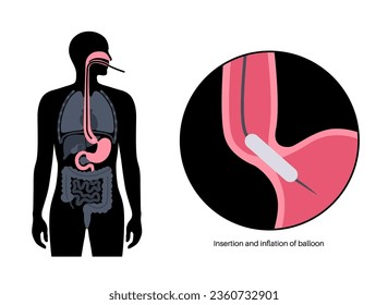 Endoscopic pneumatic dilation. Upper endoscopy minimally invasive procedure. Disorder of the esophagus, therapy for achalasia. balloon disrupts the muscle fibers in closed lower esophageal sphincter