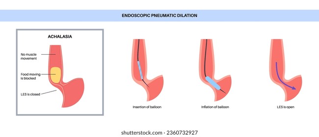 Endoscopic pneumatic dilation. Upper endoscopy minimally invasive procedure. Disorder of the esophagus, therapy for achalasia. balloon disrupts the muscle fibers in closed lower esophageal sphincter