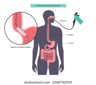 Endoscopic pneumatic dilation. Upper endoscopy minimally invasive procedure. Disorder of the esophagus, therapy for achalasia. balloon disrupts the muscle fibers in closed lower esophageal sphincter