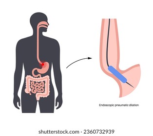 Endoscopic pneumatic dilation. Upper endoscopy minimally invasive procedure. Disorder of the esophagus, therapy for achalasia. balloon disrupts the muscle fibers in closed lower esophageal sphincter