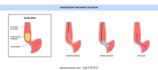 Endoscopic pneumatic dilation. Upper endoscopy minimally invasive procedure. Disorder of the esophagus, therapy for achalasia. balloon disrupts the muscle fibers in closed lower esophageal sphincter