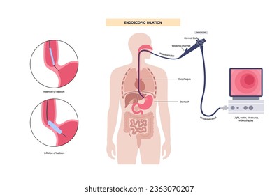 Endoscopic pneumatic dilation. Upper endoscopy minimally invasive procedure. Disorder of the esophagus, therapy for achalasia. balloon disrupts the muscle fibers in closed lower esophageal sphincter