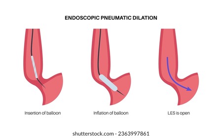 Endoscopic pneumatic dilation. Upper endoscopy minimally invasive procedure. Disorder of the esophagus, therapy for achalasia. balloon disrupts the muscle fibers in closed lower esophageal sphincter