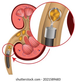 Endoscopic removal of kidney stones. Vector medical illustration
