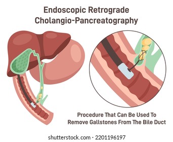 Endoscopic retrograde cholangiopancreatography. ERCP, bile duct diagnosis. Gallstones removing surgery. Flat vector illustration