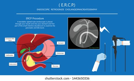 Endoscopic Retrograde Cholangiopancreatography ERCP diagnose treat device bile duct X-rays pancreatic removal material study surgery Tumor cancer infection diagnostic abdominal MRI inject