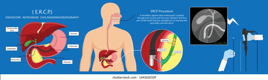 Endoscopic Retrograde Cholangiopancreatography ERCP Diagnose Treat Device Bile Duct X-rays Pancreatic Removal Material Study Surgery Tumor Cancer Infection Diagnostic Abdominal MRI Inject