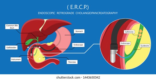 Endoscopic Retrograde Cholangiopancreatography ERCP Diagnose Treat Device Bile Duct X-rays Pancreatic Removal Material Study Surgery Tumor Cancer Infection Diagnostic Abdominal MRI Inject