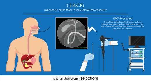 Endoscopic Retrograde Cholangiopancreatography ERCP diagnose treat device bile duct X-rays pancreatic removal material study surgery Tumor cancer infection diagnostic abdominal MRI inject