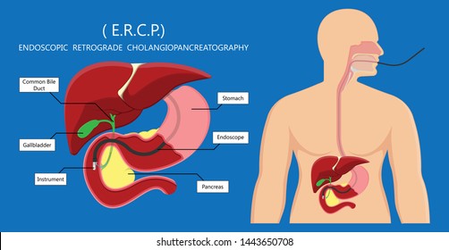 Endoscopic Retrograde Cholangiopancreatography ERCP diagnose treat device bile duct X-rays pancreatic removal material study surgery Tumor cancer infection diagnostic abdominal MRI inject