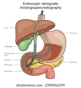 Endoscopic retrograde cholangiopancreatography structure vertebral column diagram hand drawn schematic vector illustration. Medical science educational illustration