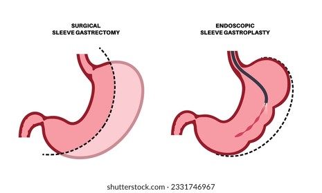 Gastroplastia de manga endoscópica y gastrectomía. Cirugía estomacal, procedimiento gástrico de pérdida de peso. Concepto de aparoscopia. Problema de sobrepeso en la ilustración médica del vector plano del cuerpo humano