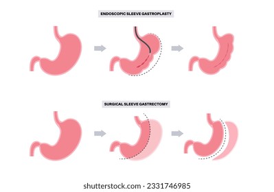 Gastroplastia de manga endoscópica y gastrectomía. Cirugía estomacal, procedimiento gástrico de pérdida de peso. Concepto de aparoscopia. Problema de sobrepeso en la ilustración médica del vector plano del cuerpo humano