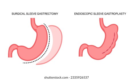 Gastroplastia de manga endoscópica y gastrectomía. Cirugía estomacal, procedimiento gástrico de pérdida de peso. Concepto de aparoscopia. Problema de sobrepeso en la ilustración médica del vector plano del cuerpo humano