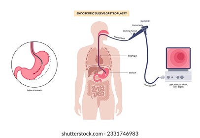 Endoscopic sleeve gastroplasty. Stomach surgery, weight loss gastric procedure. Laparoscopy concept. Overweight problem in human body. Internal organ after operation. Flat vector medical illustration